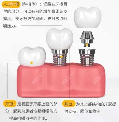 做过种植牙的人谈体会