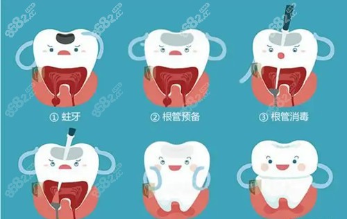 根管治疗过程