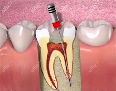 根尖周炎的治疗3