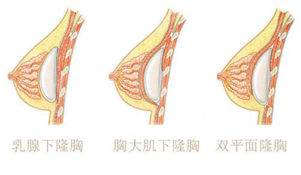 假体隆胸方式示意