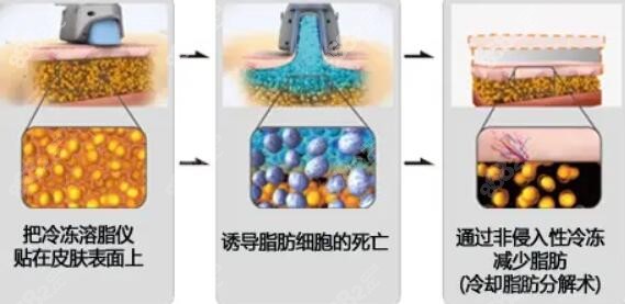 冷冻溶脂术和激光溶脂术有啥区别？