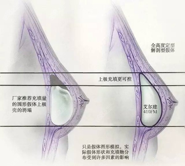 水滴型与圆型假体丰胸示意