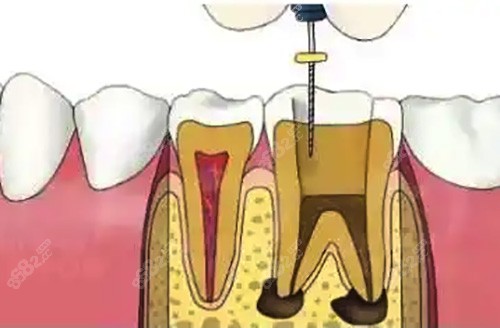 牙齿根管治疗处理