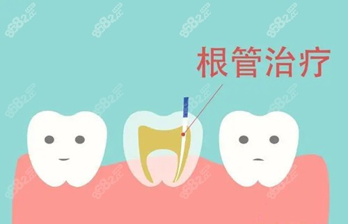 根管治疗亲身经历