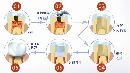 根管治疗过程详解