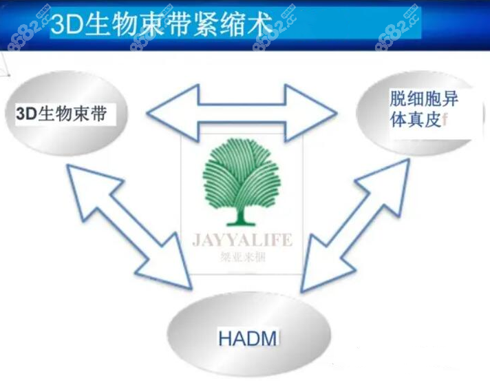 3d/4d生物束带紧缩术原理