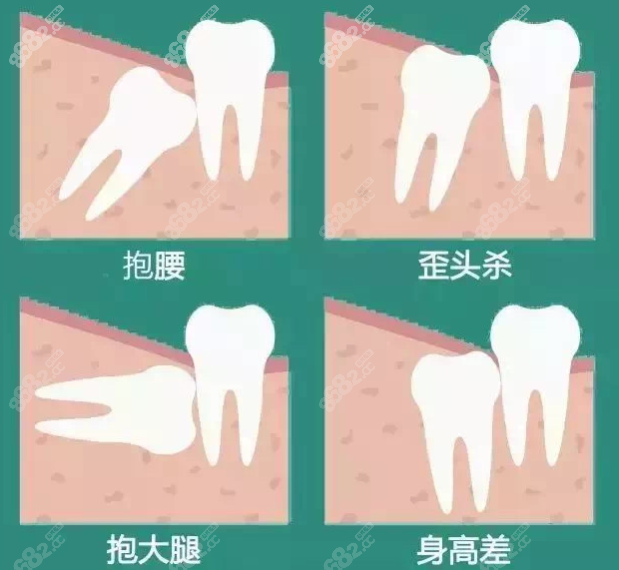 义乌拔智齿价格一般多少钱一颗