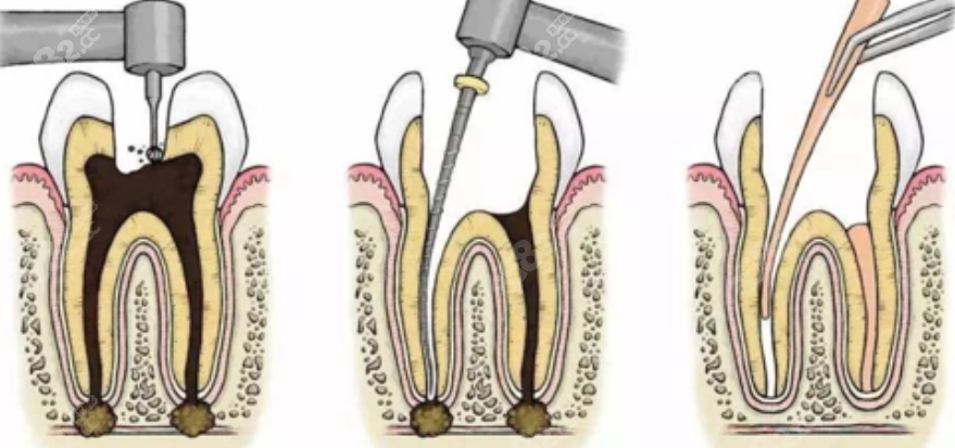 根管治疗示意图