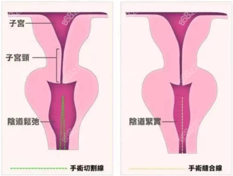 普通缩阴手术图示