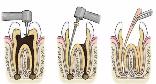 根管治疗