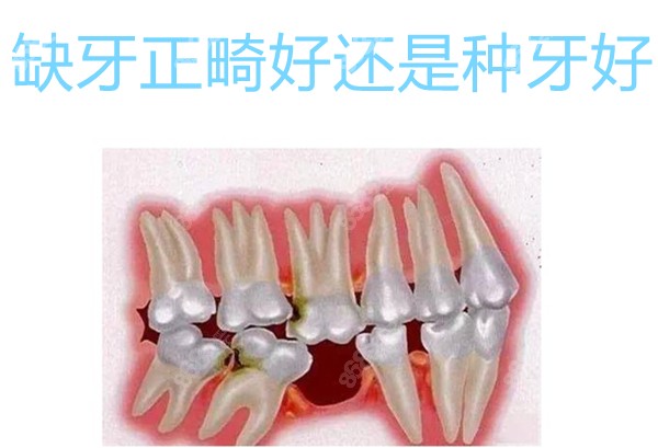 缺牙正畸好还是种牙好