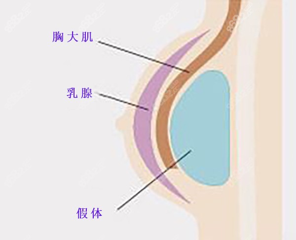 丰胸假体植入位置示意