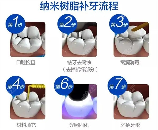 纳米树脂补牙的流程和步骤