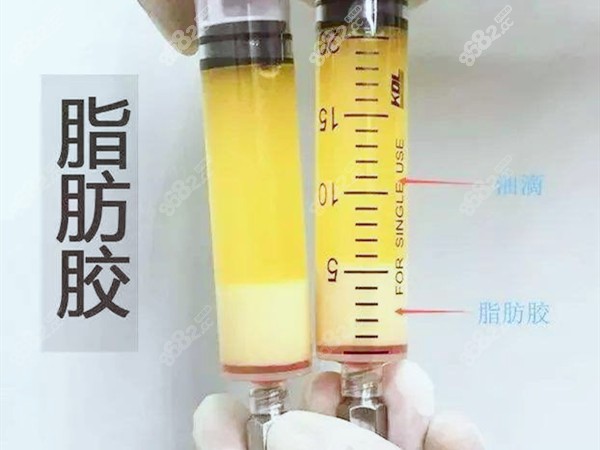 鼻基底填充怎么做