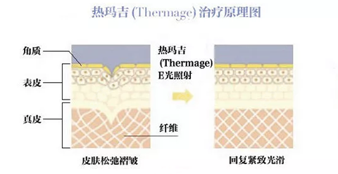 热玛吉治疗原理图