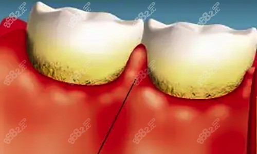 牙龈炎的早期三大症状