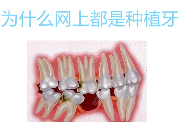 为什么网上都是种植牙