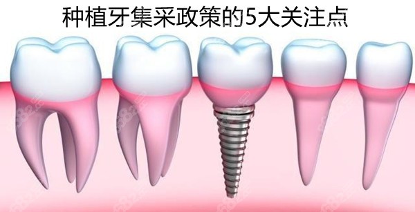 种植牙集采政策的5个关注点