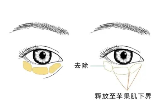 眶隔脂肪在哪里图片