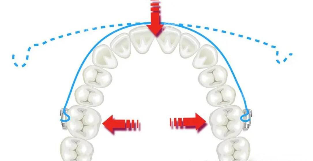 牙齿矫正的过程