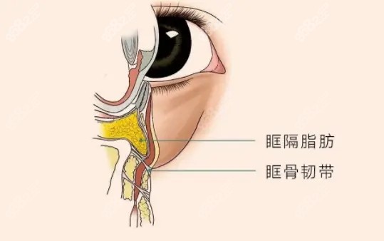 千万别做眶隔脂肪释放祛眼袋是因为难度较大