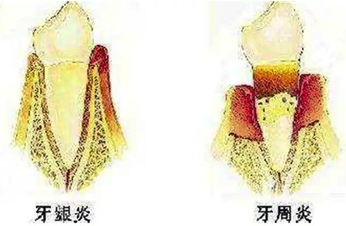 如何分辨牙周炎和牙龈炎