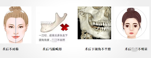 需要做下颌角修复的几种情况