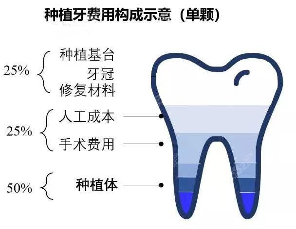 一颗种植牙的费用组成