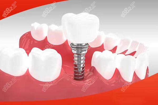 秦淮區(qū)種植牙好的醫(yī)院