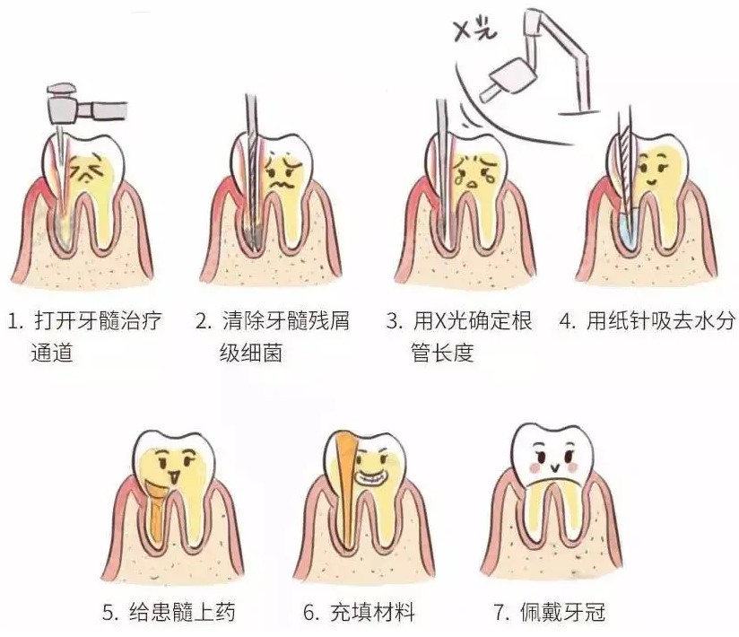 根管治疗过程