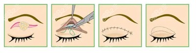 汪树杰医生在双眼皮手术方面的技术优势1