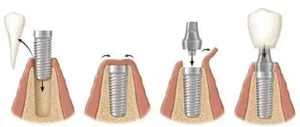 种植牙过程示意图