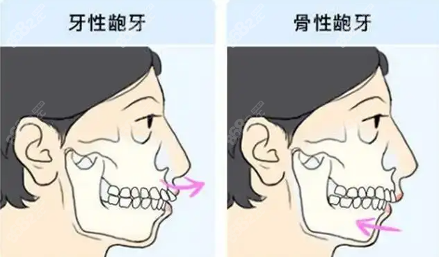 骨性龅牙手术费用图片