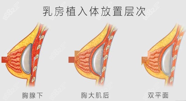 乳房假体放置层次