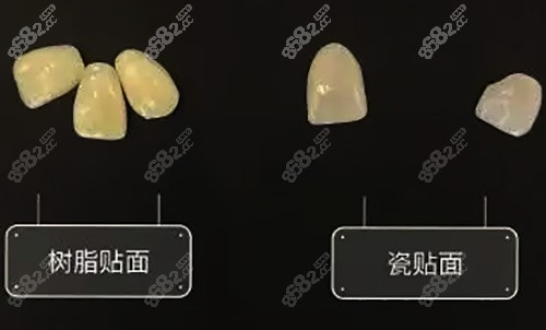 分为树脂贴面和瓷贴面两种