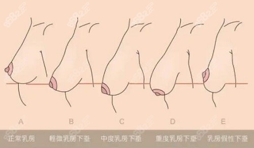 乳房下垂的不同程度