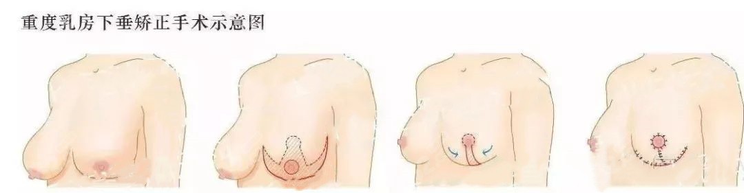 重度乳房下垂采用乳房提升手術倒t型矯正