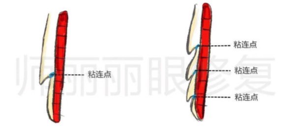 北京双眼皮修复师丽丽眼修复优势