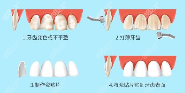 牙齿瓷贴面过程