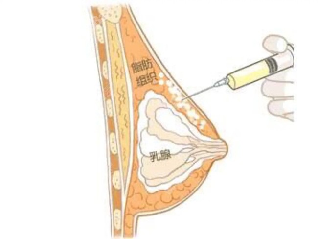 注射隆胸手术原理