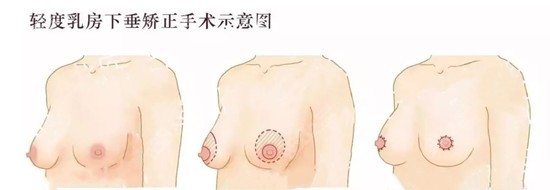 輕度乳房下垂采用雙環法乳房上提懸吊固定術矯正