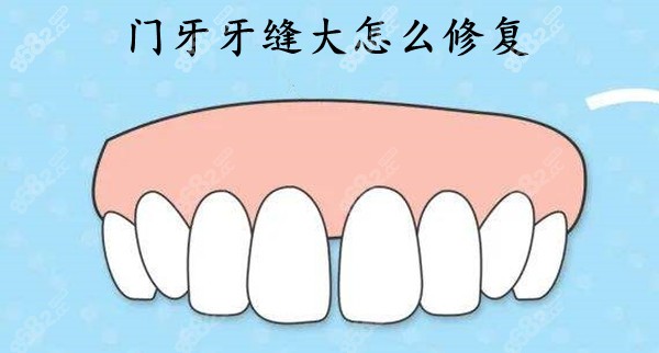 门牙牙缝大2-5mm怎么修复