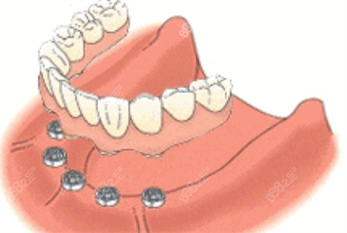 半口牙齿种植示意图