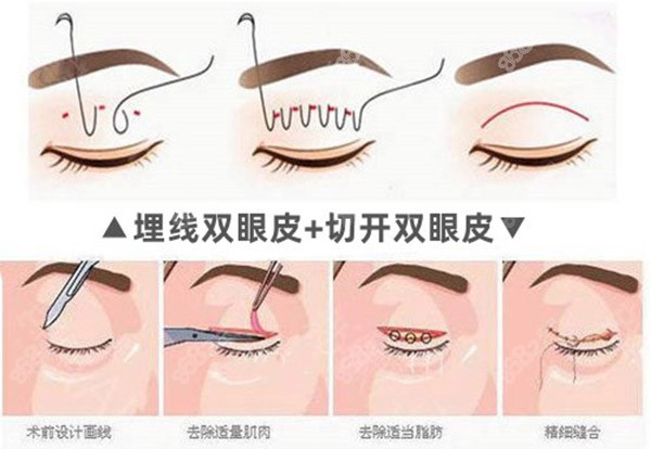 双眼皮