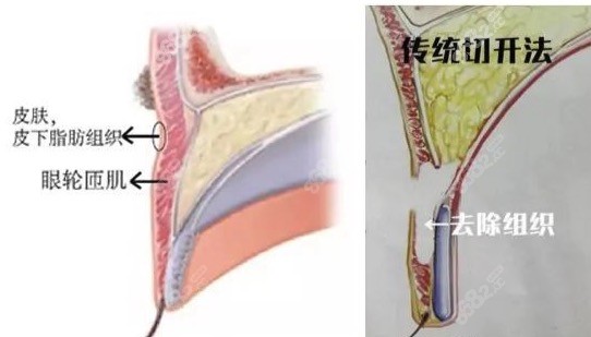 北京双眼皮修复师丽丽眼修复优势