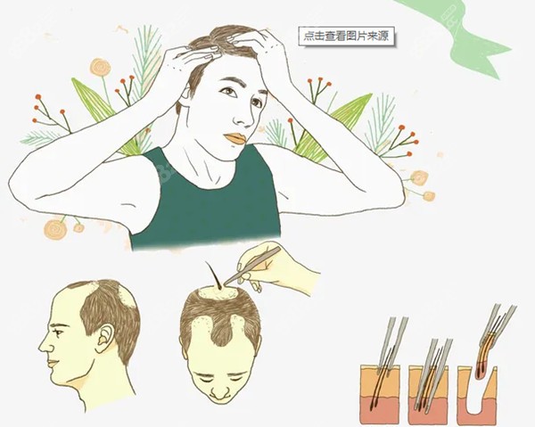 揭秘植發(fā)醫(yī)院的套路