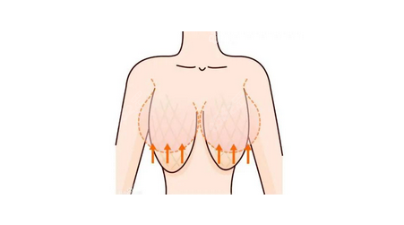 乳房下垂怎么办改善