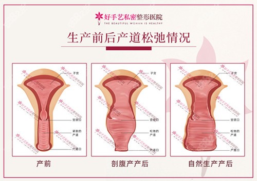 产后阴道松弛怎么办