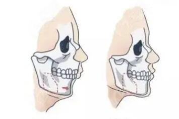 正颌手术的过程图解