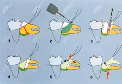 横向阻生齿的拔除2